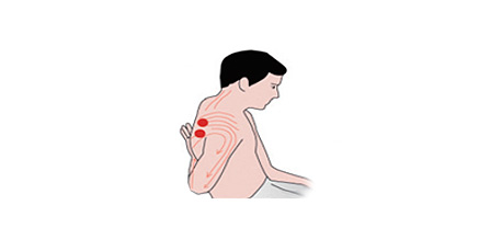 الليفي العضلي الألم متلازمة-04