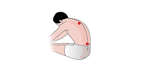 الليفي العضلي الألم متلازمة-05